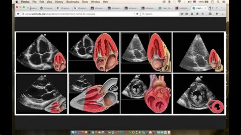 The basics of echocardiography .